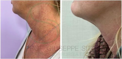 liposuzione del collo 1