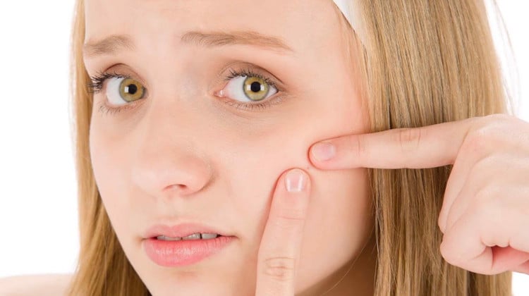 acne-ha-giorni-contati