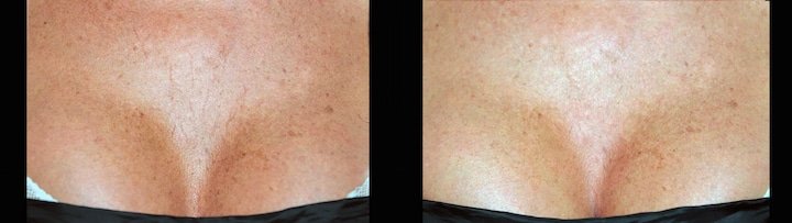 ridensificazione dinamica prima e dopo