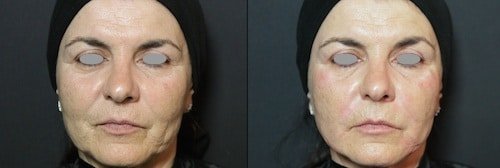 biorivitalizzazione 11