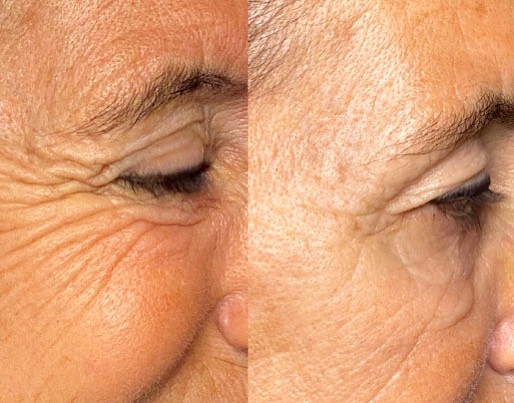 Botox botulino Prof Giuseppe Sito Caso 1