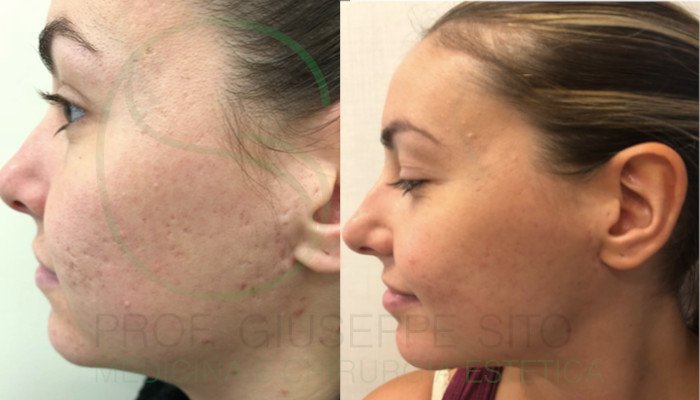 Needling-2 Prof Giuseppe Sito
