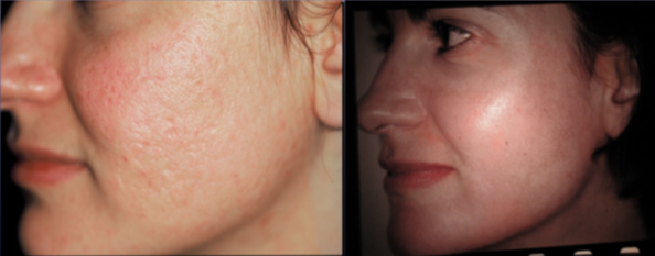 trattamento-cicatrici-acne-caso4_Giuseppe-Sito