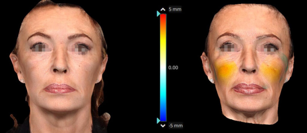 Figure 2. Frontal view with color scale, after and before injection therapy—patient 1.
