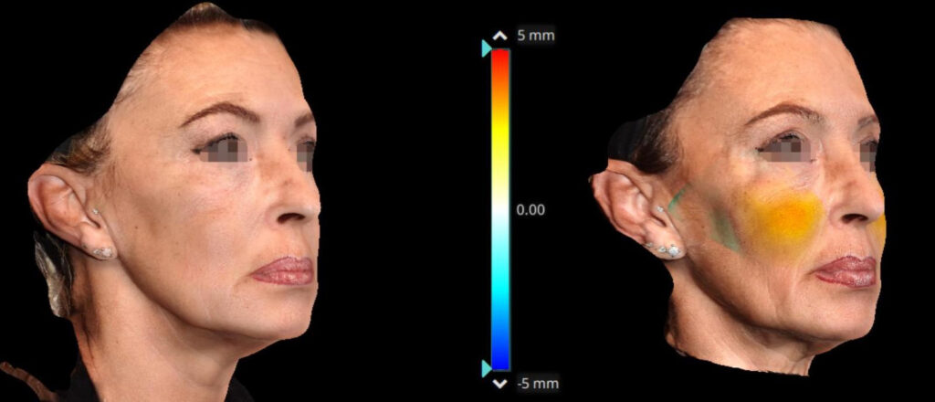 Figure 3. Oblique view with color scale, after and before injection therapy—patient 1.