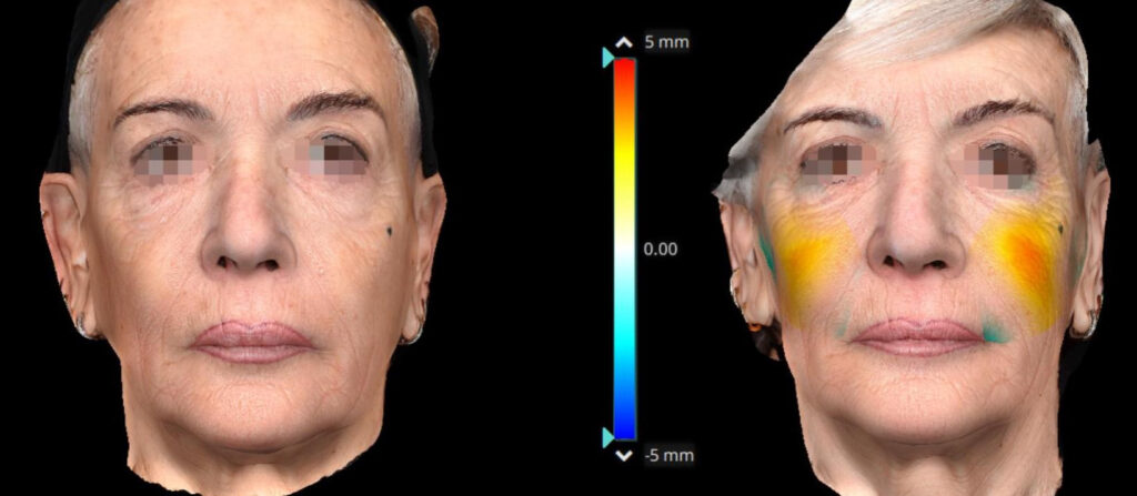 Figure 5. Frontal view with color scale, after and before injection therapy—patient 2.