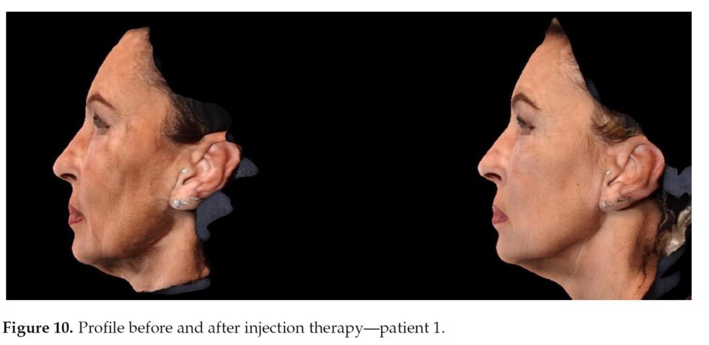 Figure 10. Profile before and after injection therapy—patient 1.