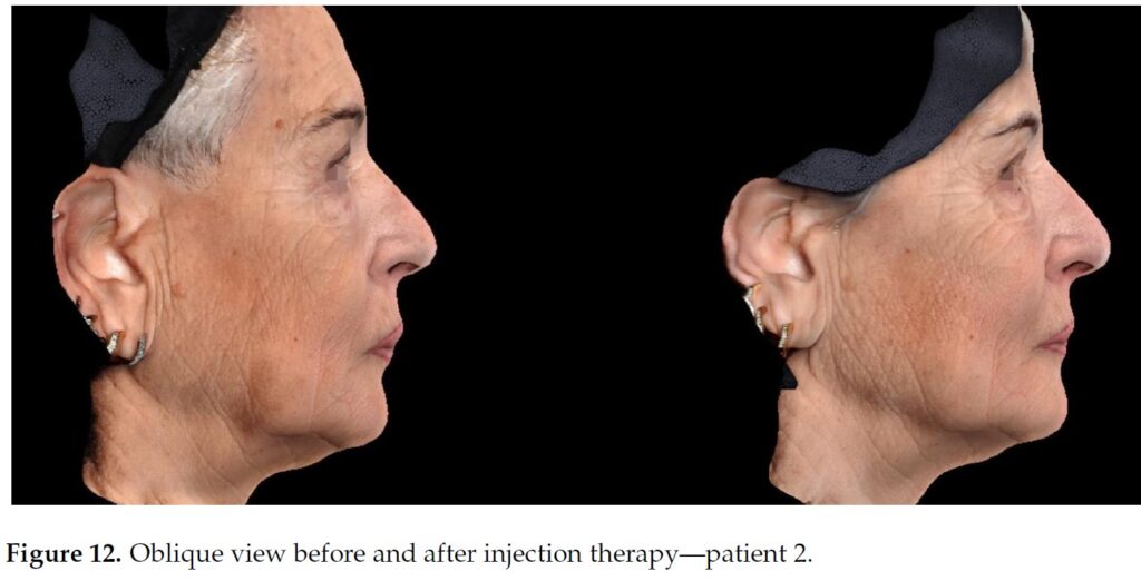 Figure 12. Oblique view before and after injection therapy—patient 2