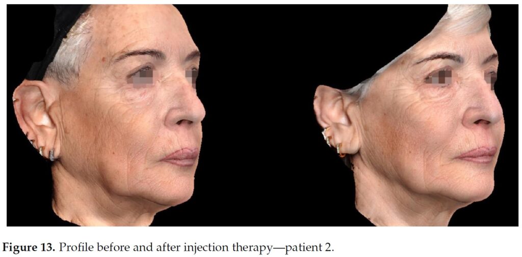 Figure 13. Profile before and after injection therapy—patient 2.