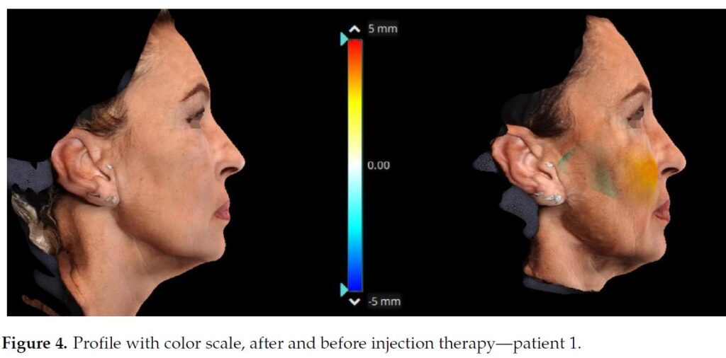 Figure 4. Profile with color scale, after and before injection therapy — Patient 1.