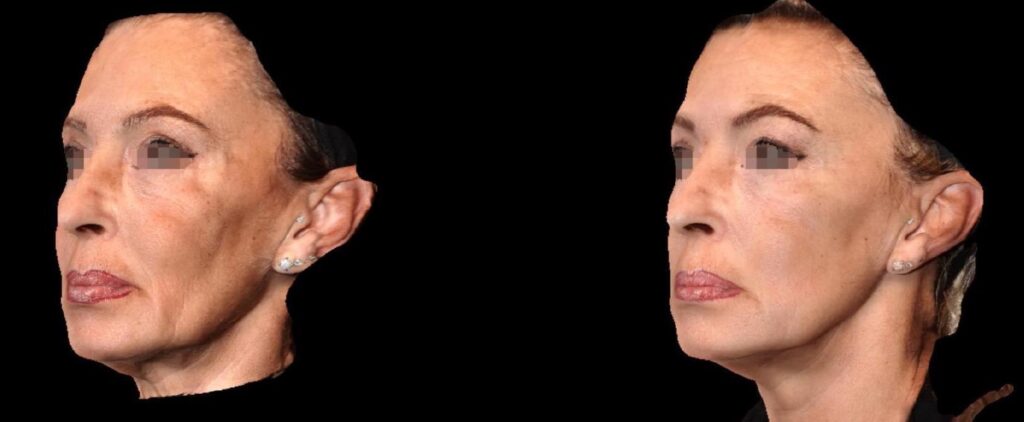 Figure 9. Oblique view before and after injection therapy—patient 1