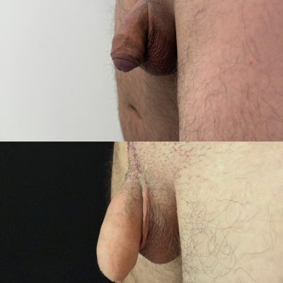 falloplastica lipopenoscultura 2025 5